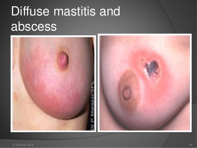 breast mastitis abscess Breast mastitis abscess
